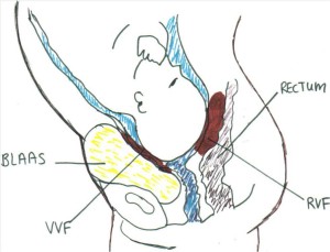 VVF anatomische tekening